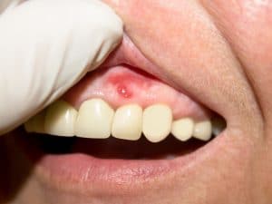 Up close view of a mouth with an ulcer on the gums.