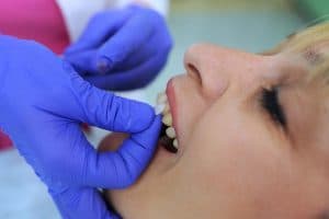 Dentist putting dental veneers on a female patient's teeth.