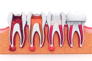 Model of the stages of root canal treatment.