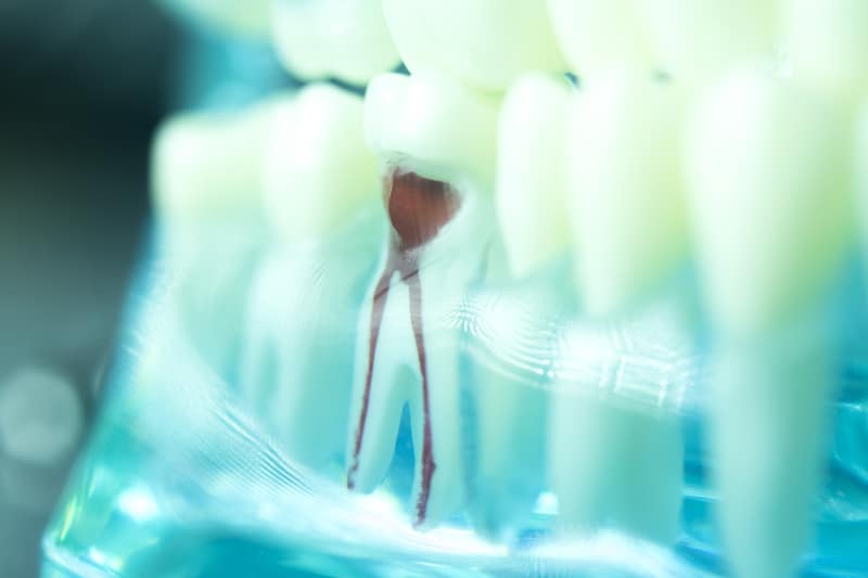 Up close view of tooth model that shows an infected tooth due for a root canal.