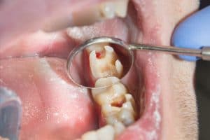 Picture of tooth with hole in it being looked at by dentist