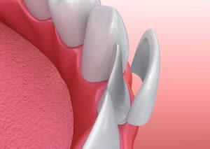 Porcelain veneer installation procedure