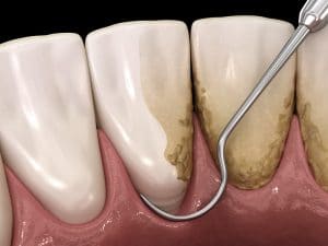 Animated model of a root planing and scaling treatment for teeth.