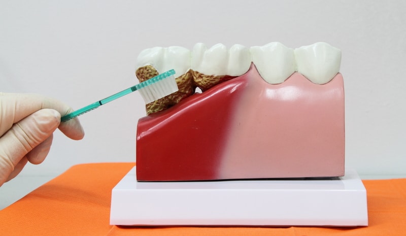 Model of the gums and teeth to show what gum disease looks like.