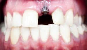 A macro shot of a dental implant in a person's mouth for cosmetic dentistry