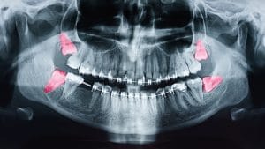 X-ray showing wisdom teeth in mouth