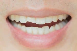 Person smiling with a chipped front tooth